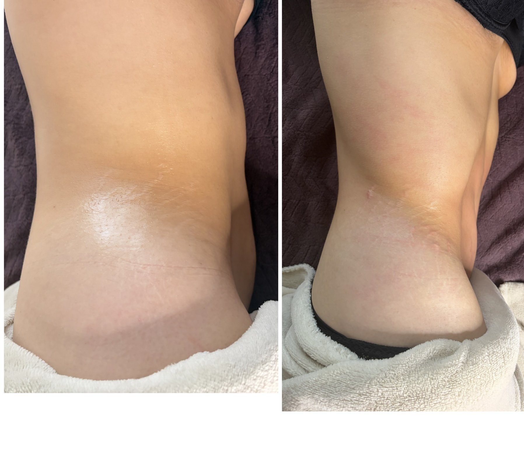 Sculpt Drain jambes avant après