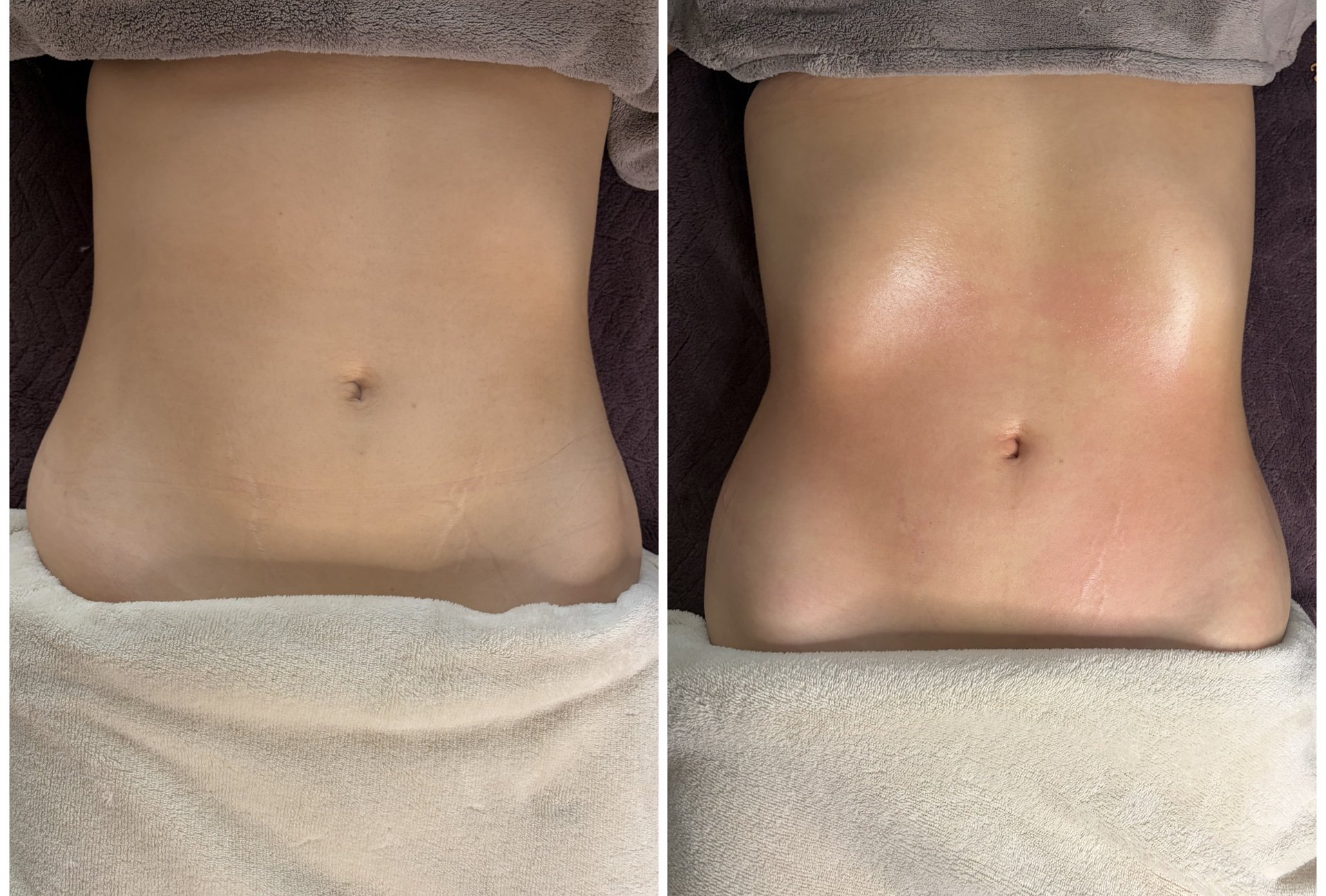 Sculpt Drain ventre avant après