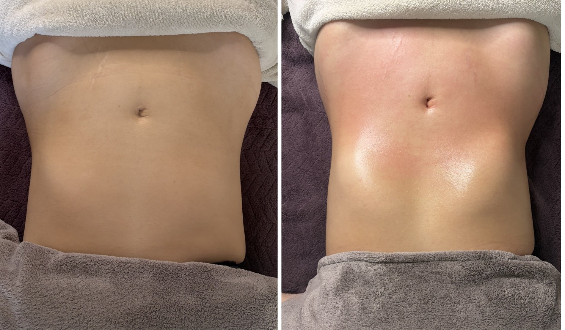 Sculpt Drain ventre 2 avant après
